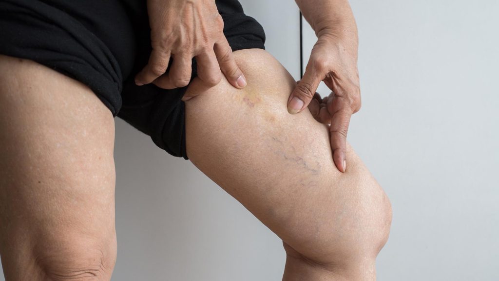 6 Things to Know About Varicose Veins