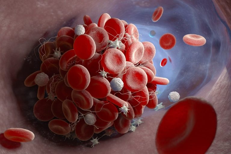 Can Varicose Veins Cause Blood Clots Kafri Wellness Clinic