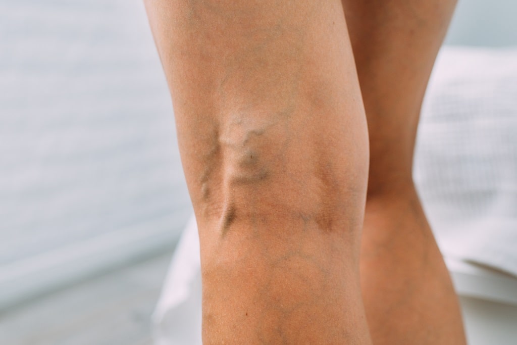 What are the stages of chronic venous insufficiency?