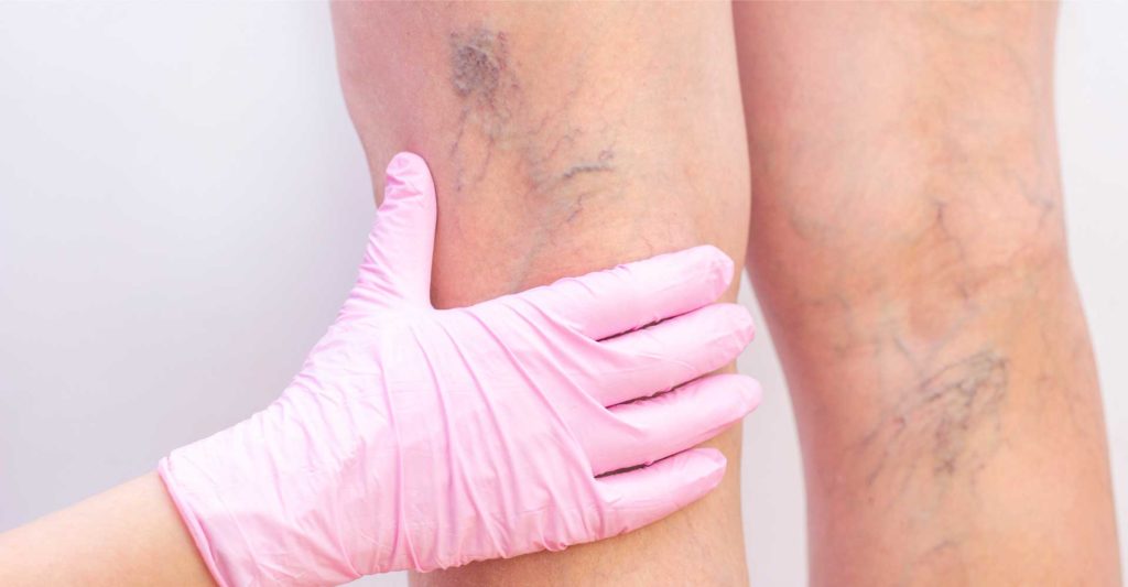 Common signs to help identify Deep Vein Thrombosis